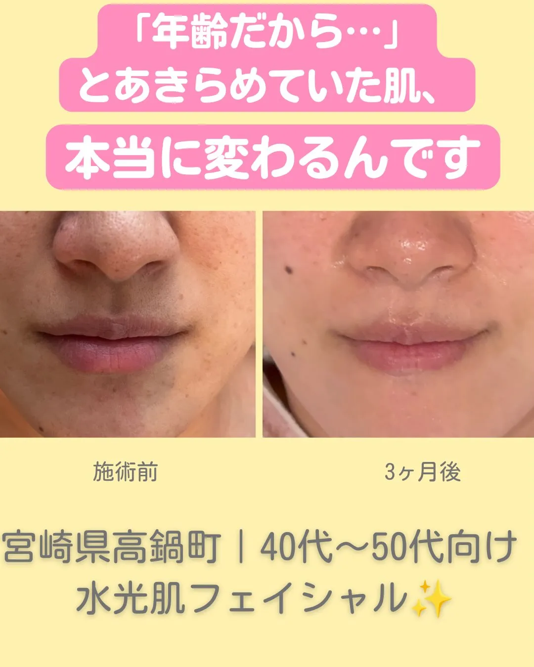 宮崎県児湯郡高鍋の肌再生サロン、Fikaの竹原です😊